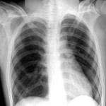 Chest X-ray