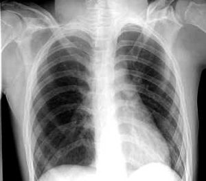 Chest X-ray Chest X-ray